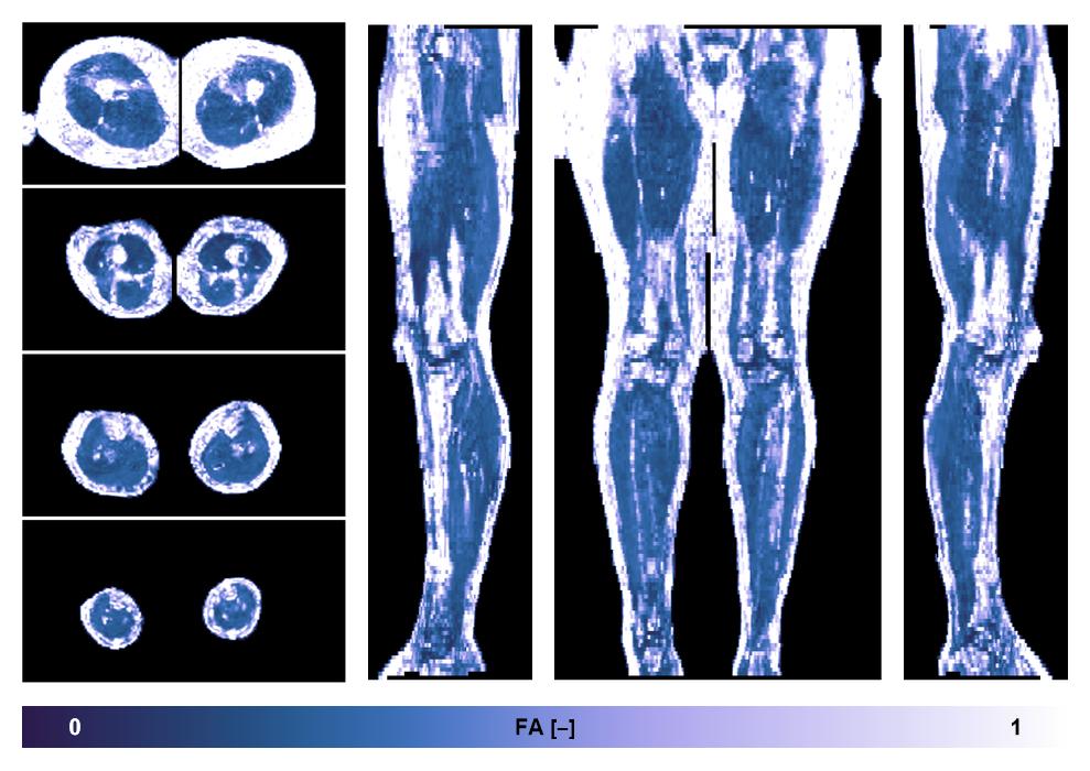 IVIM corrected whole leg muscle fractional anisotropy obtained from diffusion tensor imaging.